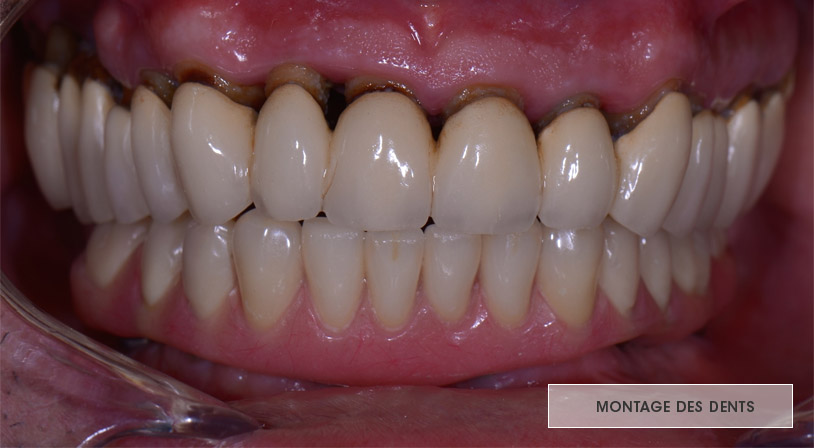 prothèse dentaire montage esthétique et fonctionnel des dents